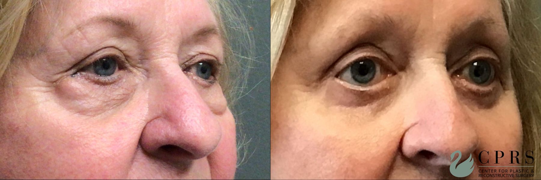Before and after Blepharoplasty case 23854 - Angle 3