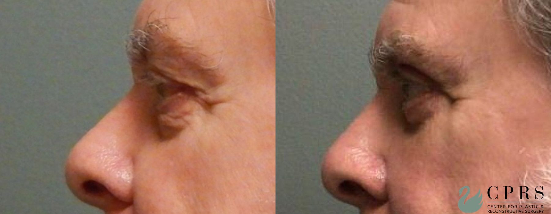 Before and after Blepharoplasty case 18972 - Angle 2