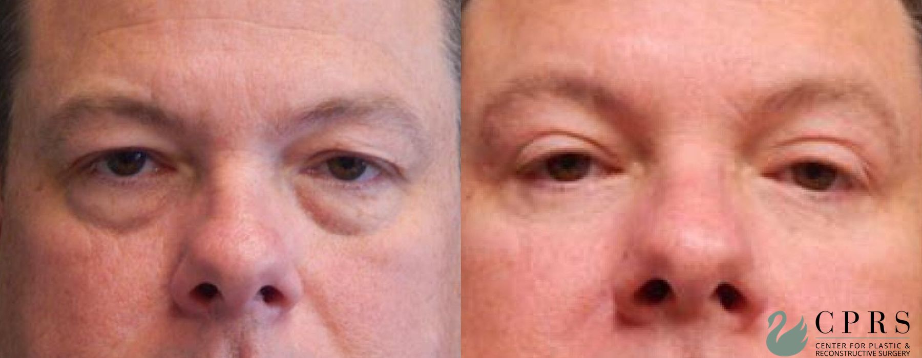 Blepharoplasty - Case 239701