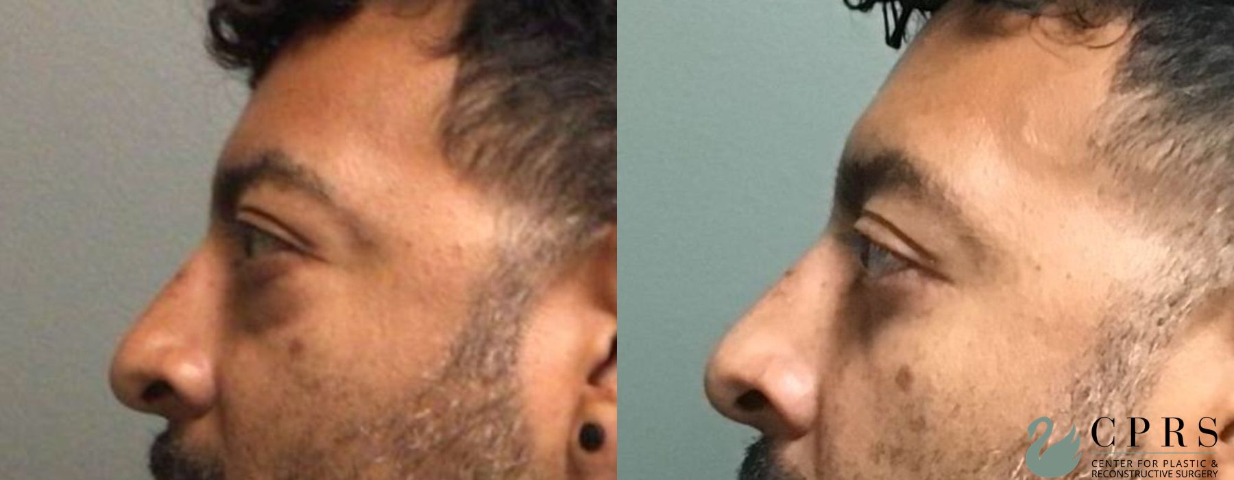 Before and after Blepharoplasty case 19004 - Angle 2