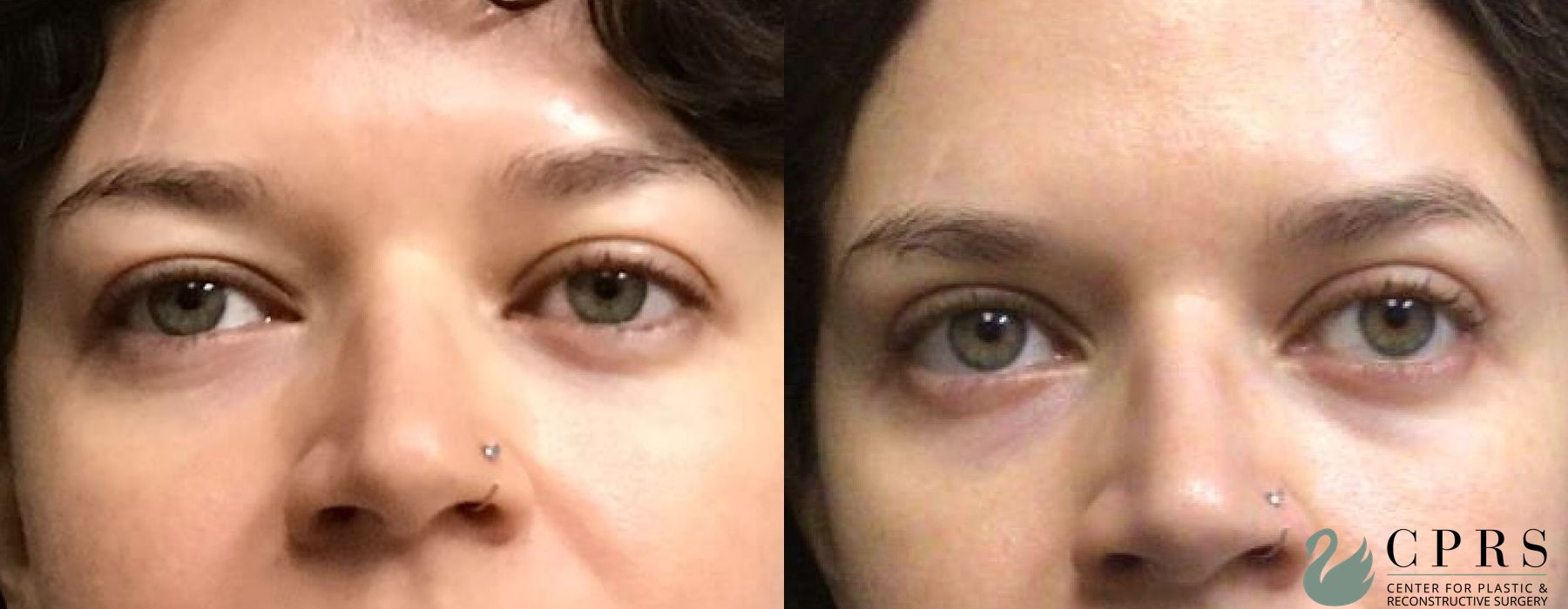 Before and after Blepharoplasty case 18998