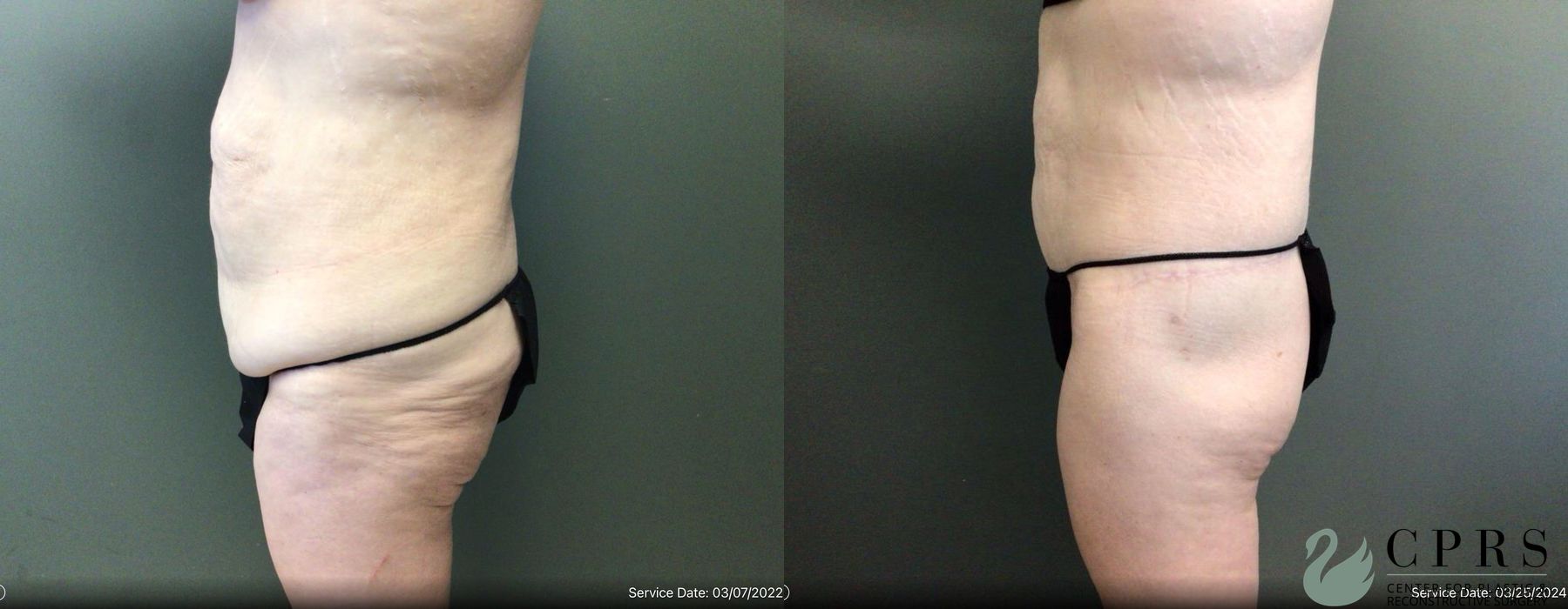 Before and after Body Lift case 19175 - Angle 2