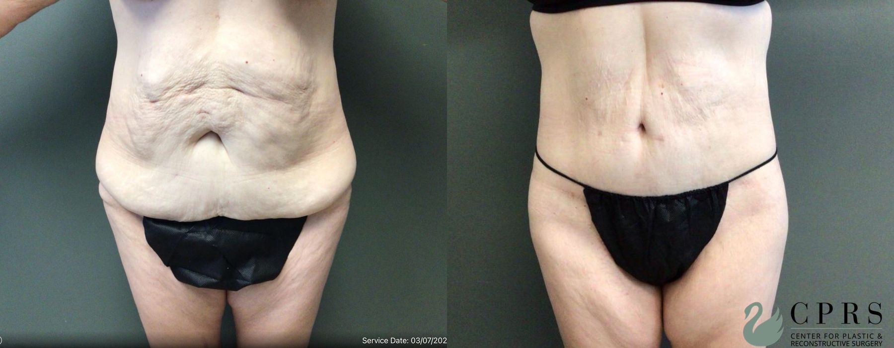 Before and after Body Lift case 19175