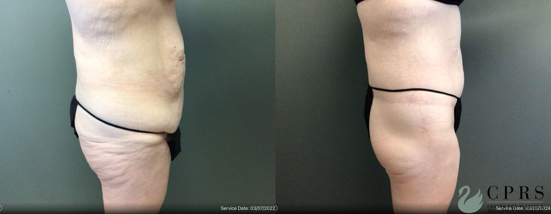 Before and after Body Lift case 19175 - Angle 3