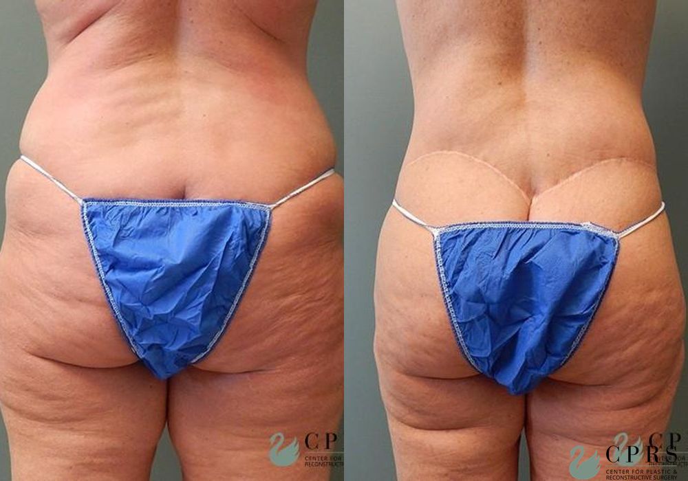 Body Lift - Thumbnail 2