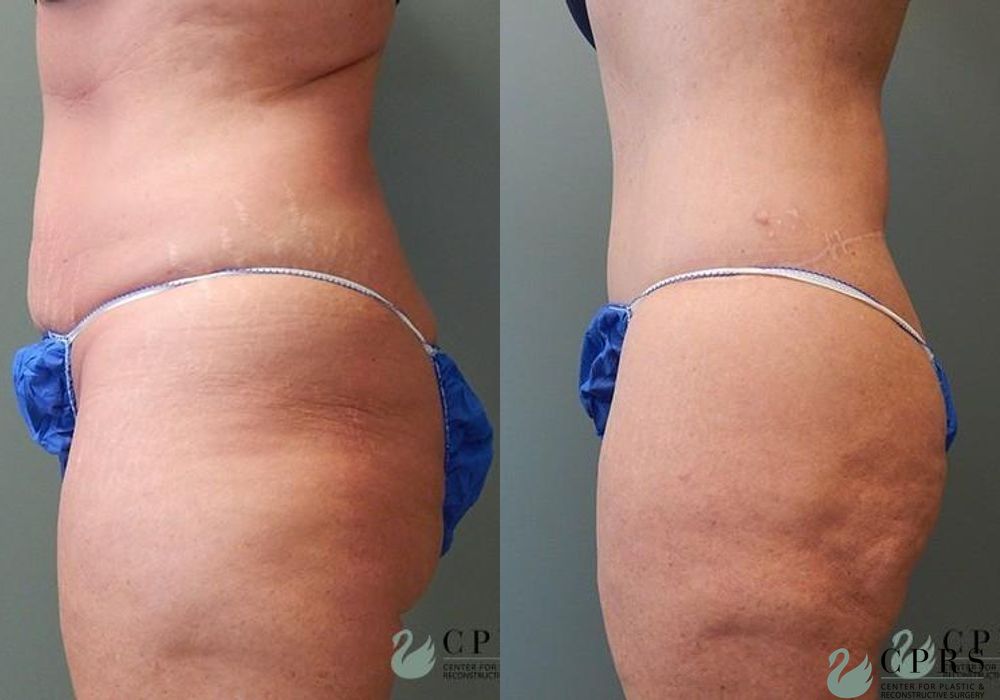 Body Lift - Thumbnail 3