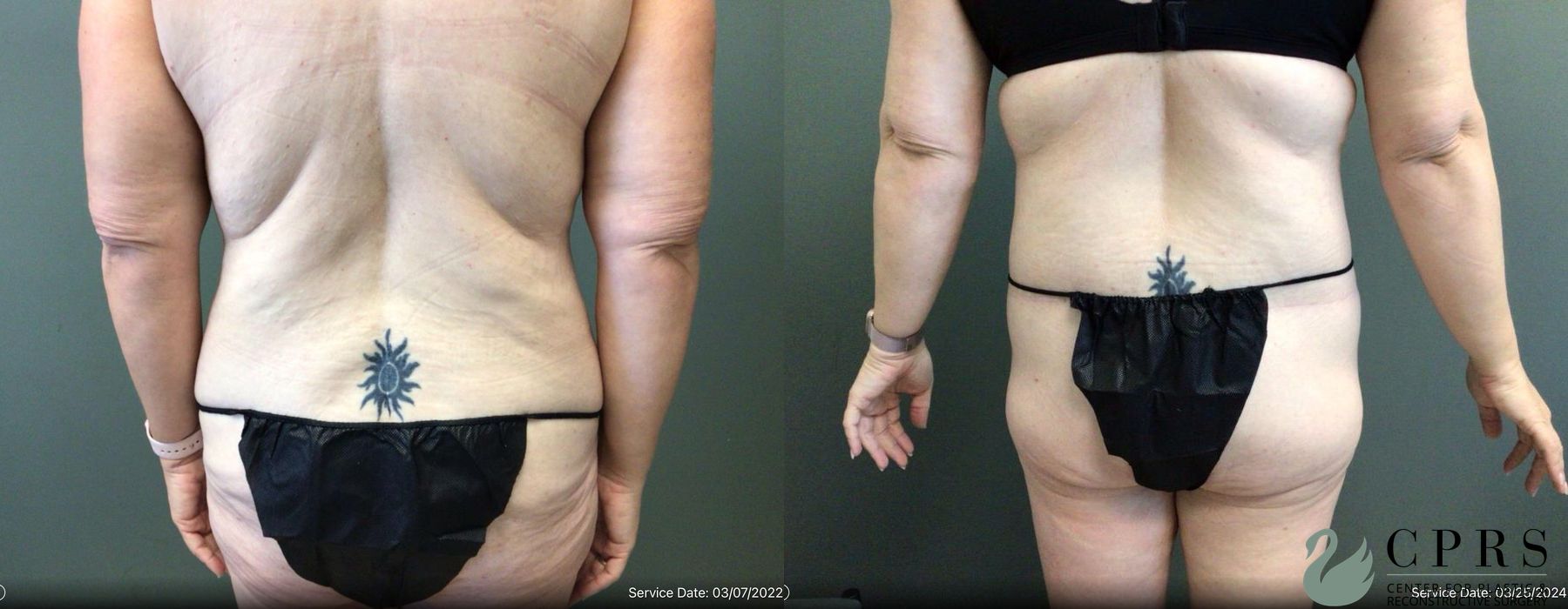 Before and after Body Lift case 19175 - Angle 4