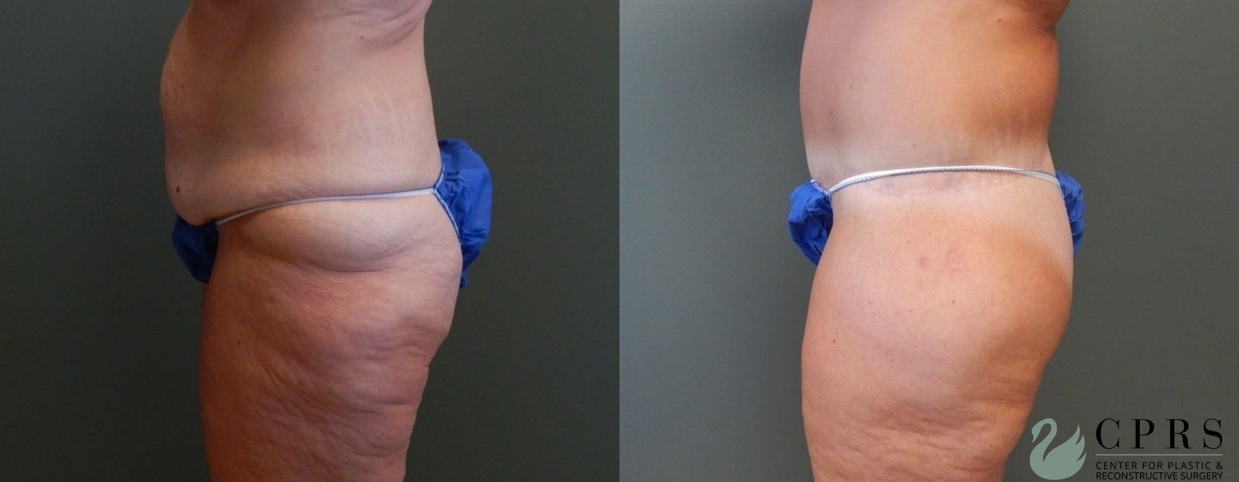 Body Lift - Thumbnail 2