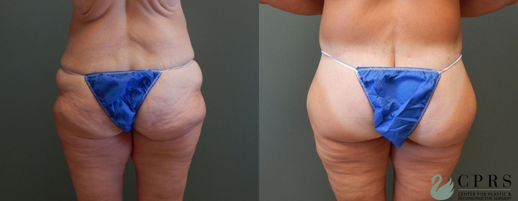 Body Lift - Thumbnail 4