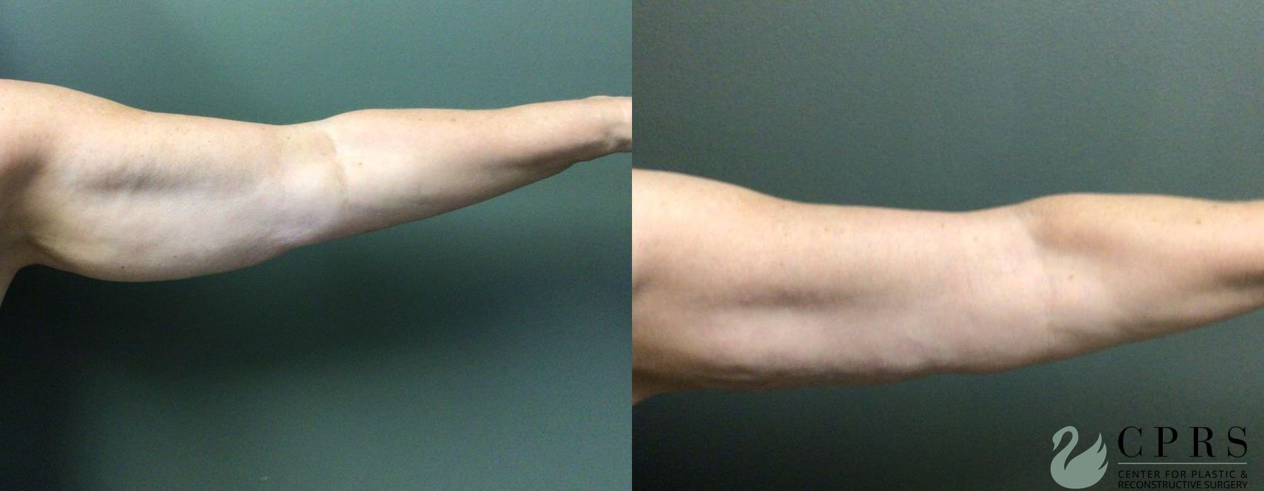 Before and after BodyTite case 19103 - Angle 2