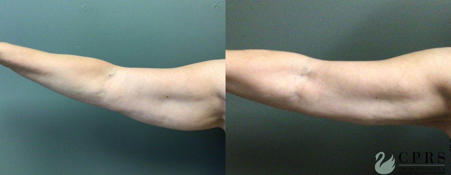 Before and after BodyTite case 19103