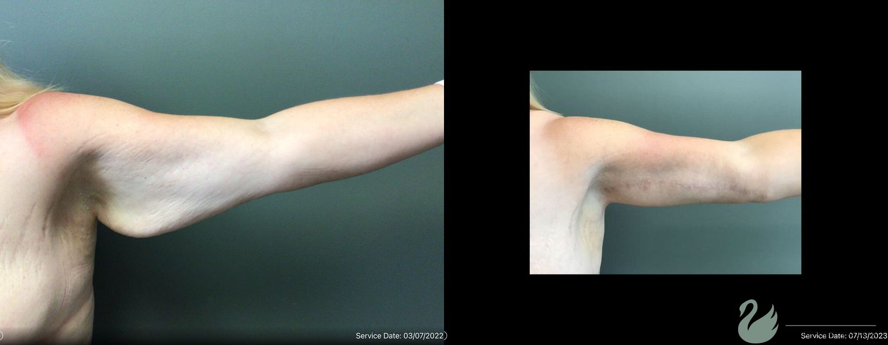 Before and after Brachioplasty case 19064