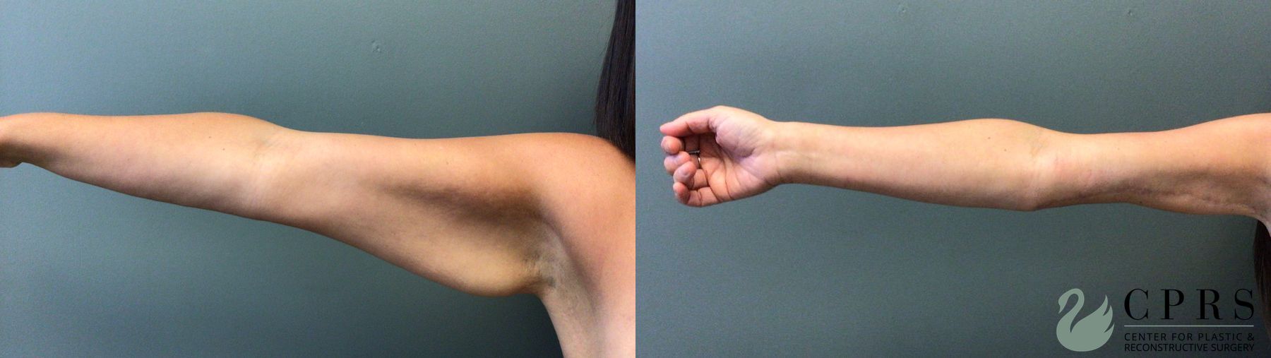 Before and after Brachioplasty case 41320 - Angle 2