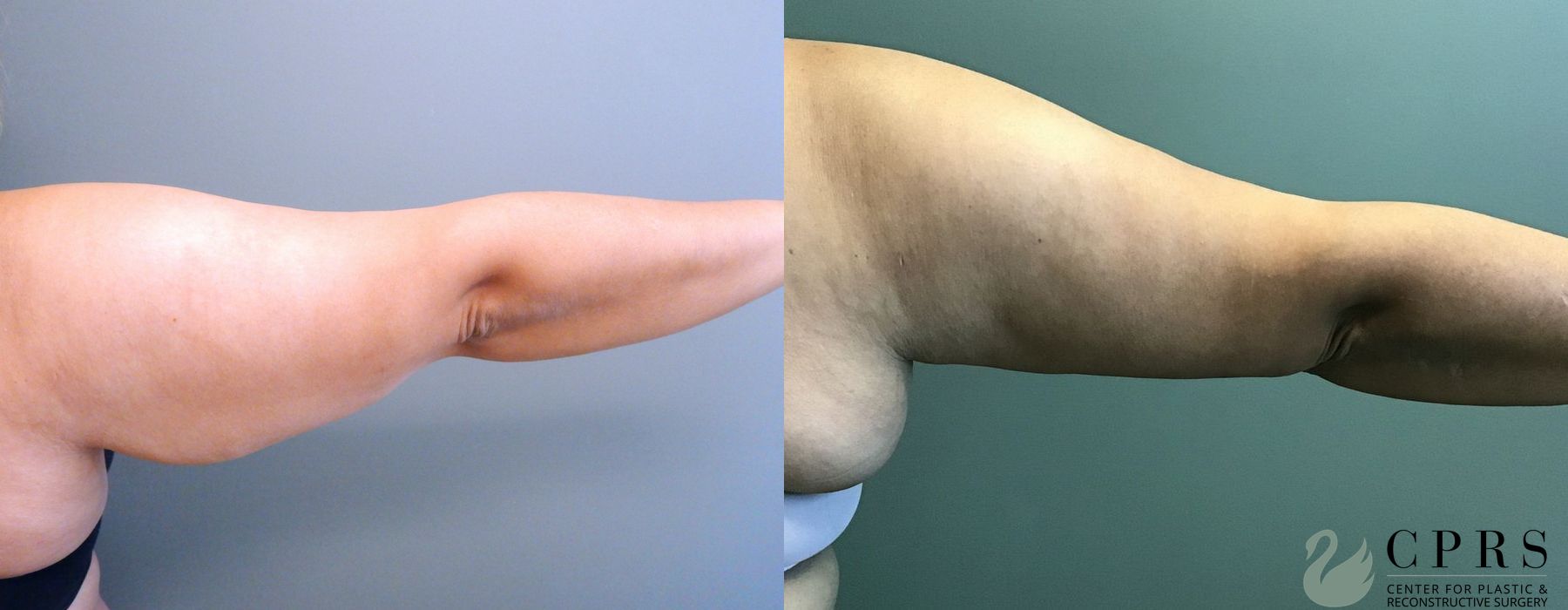 Before and after Brachioplasty case 18941 - Angle 3