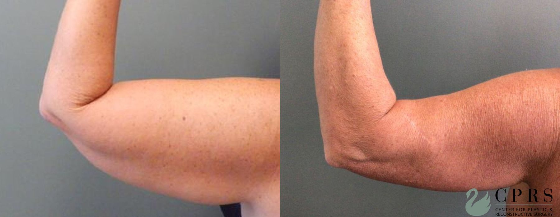 Before and after Brachioplasty case 19071 - Angle 3