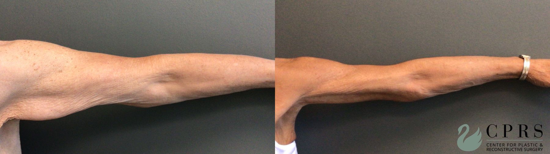 Before and after Brachioplasty case 41333 - Angle 4