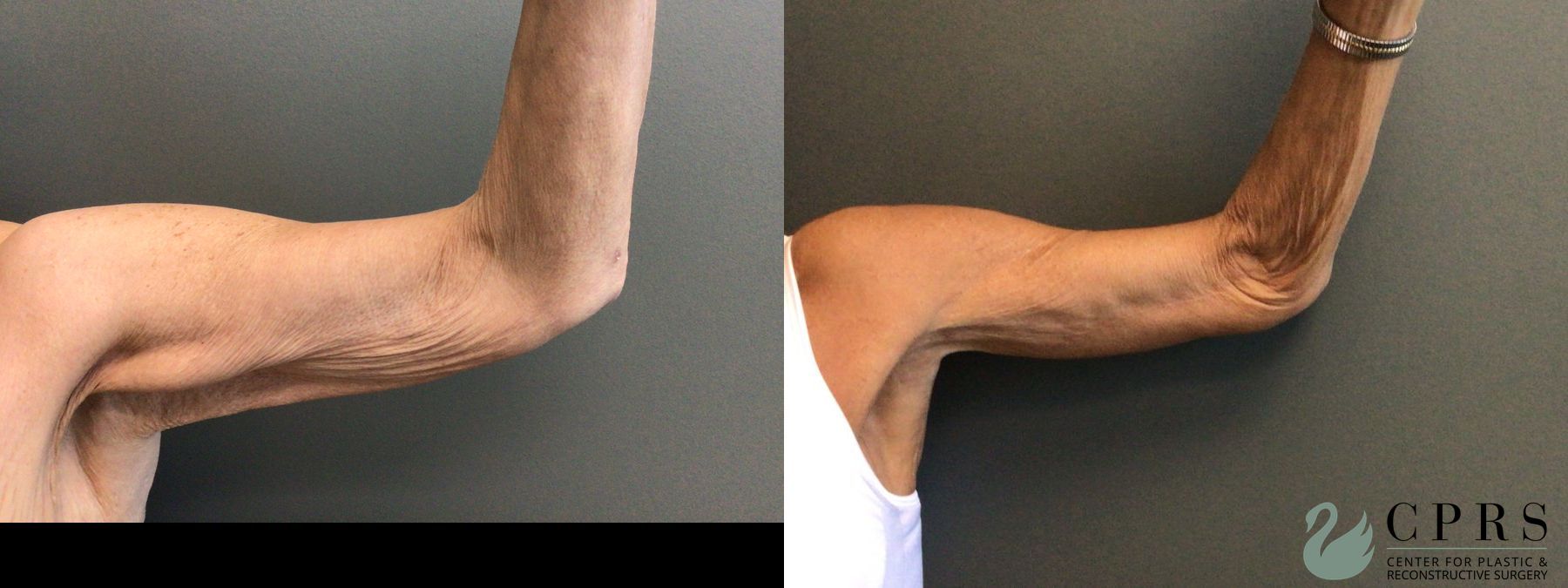 Before and after Brachioplasty case 41333 - Angle 2