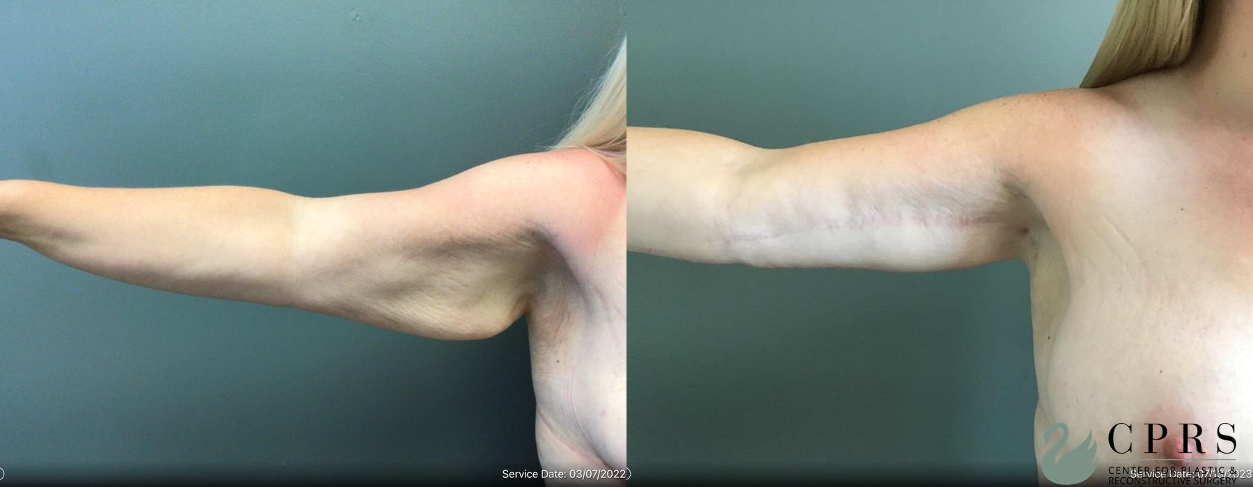 Before and after Brachioplasty case 19064 - Angle 2