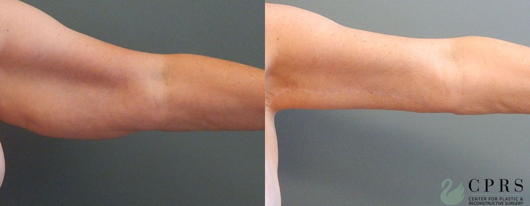Before and after Brachioplasty case 18921 - Angle 2