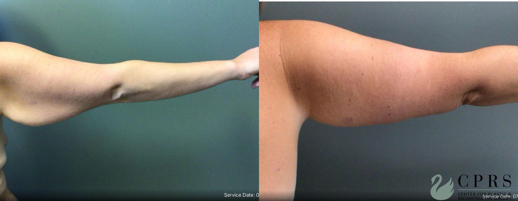 Before and after Brachioplasty case 19195 - Angle 3