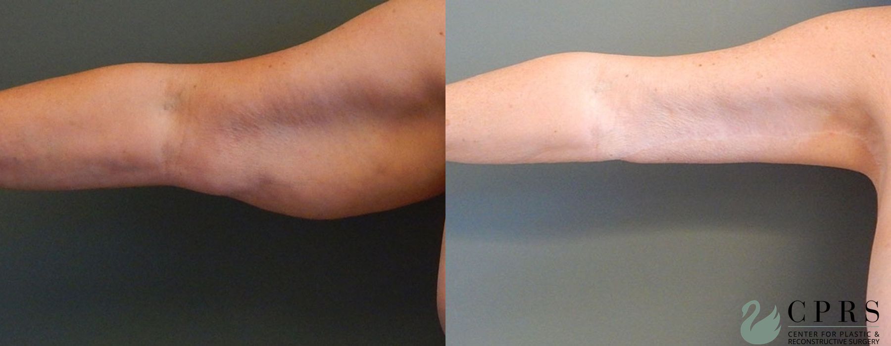 Before and after Brachioplasty case 18921