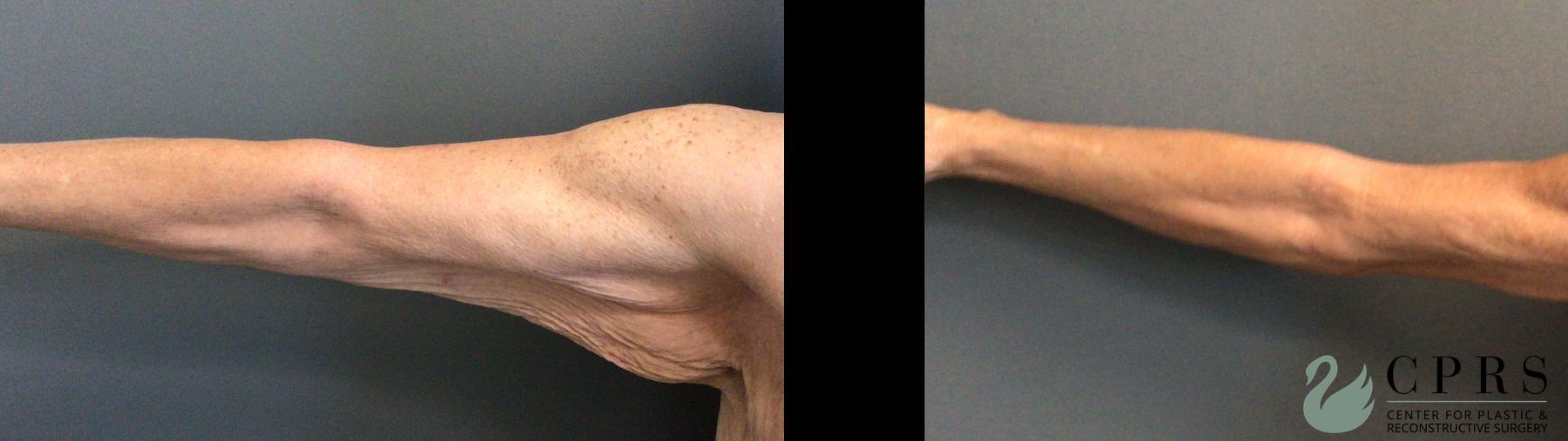 Before and after Brachioplasty case 41333 - Angle 3