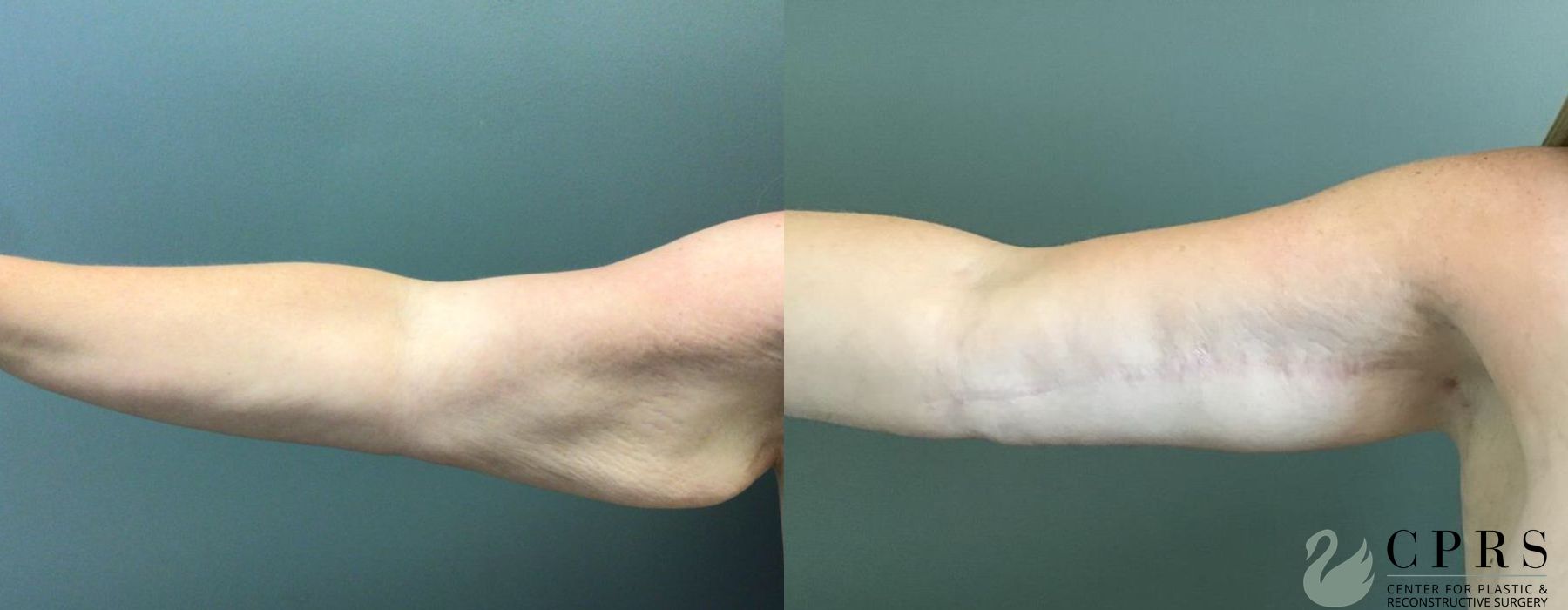 Before and after Brachioplasty case 19144