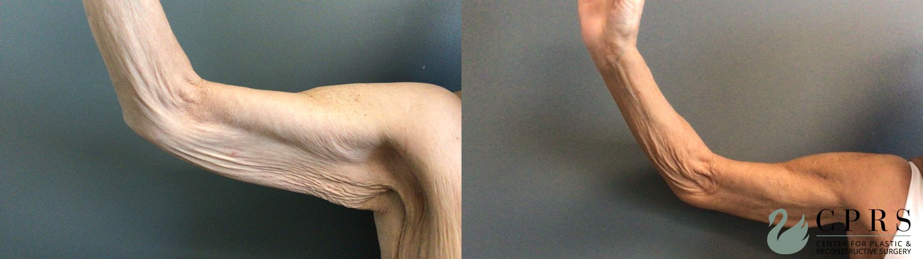 Before and after Brachioplasty case 41333