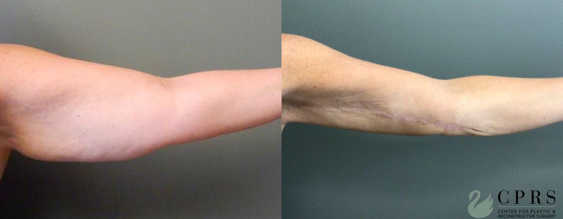 Before and after Brachioplasty case 19071 - Angle 2