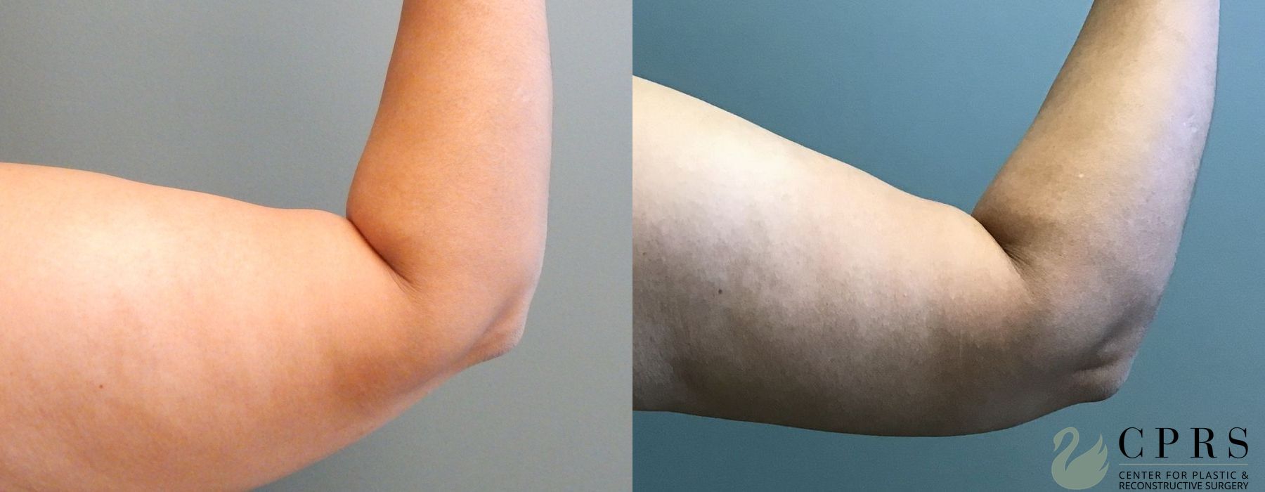 Before and after Brachioplasty case 18941 - Angle 2