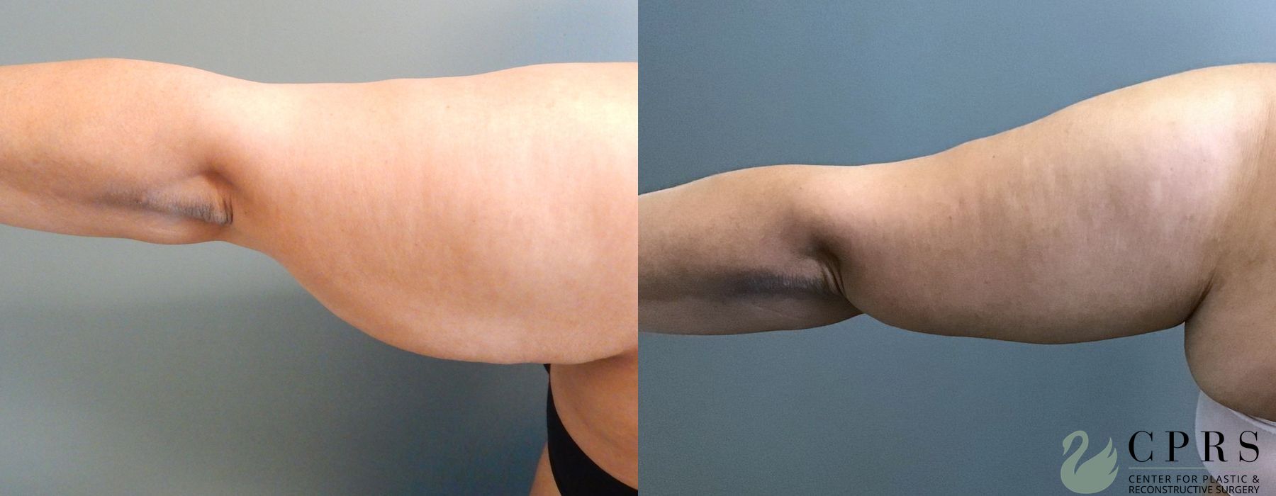 Before and after Brachioplasty case 18941