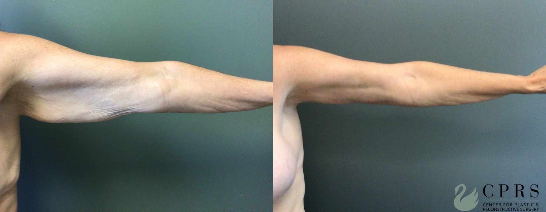 Before and after Brachioplasty case 21470