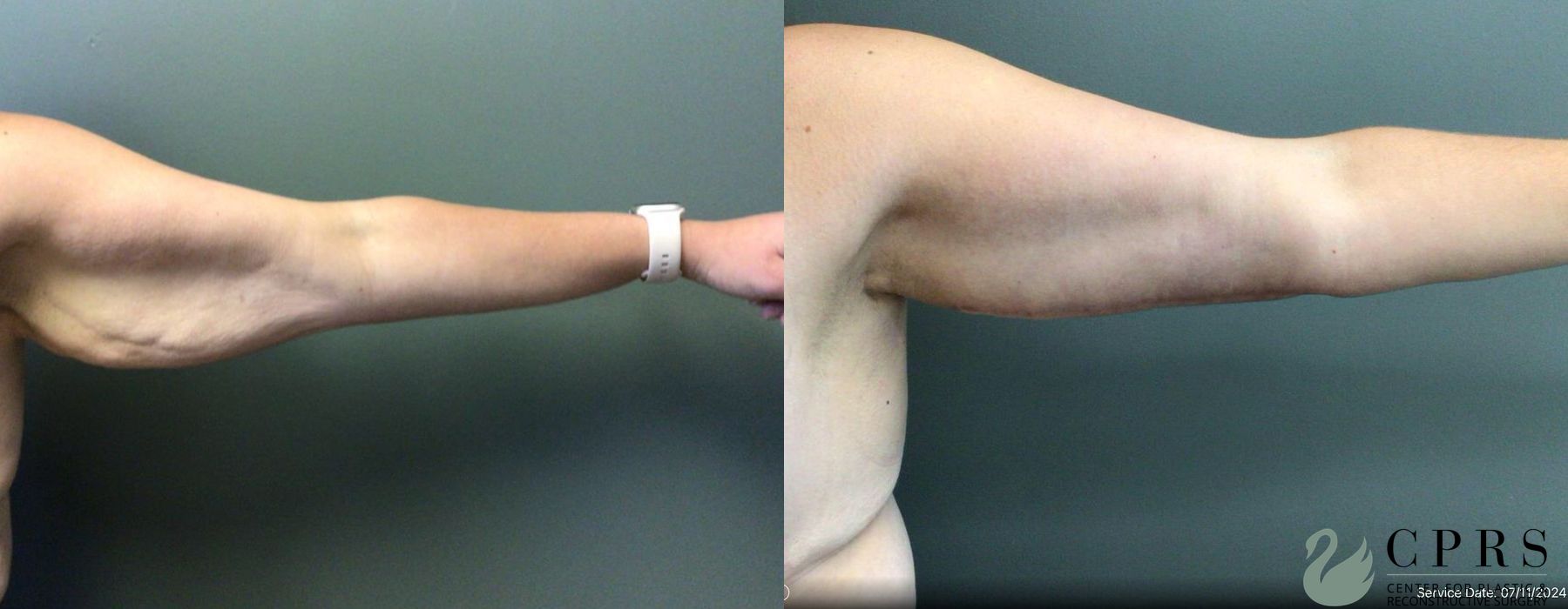 Before and after Brachioplasty case 19195 - Angle 2