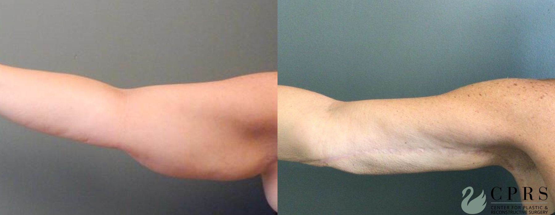 Before and after Brachioplasty case 19071