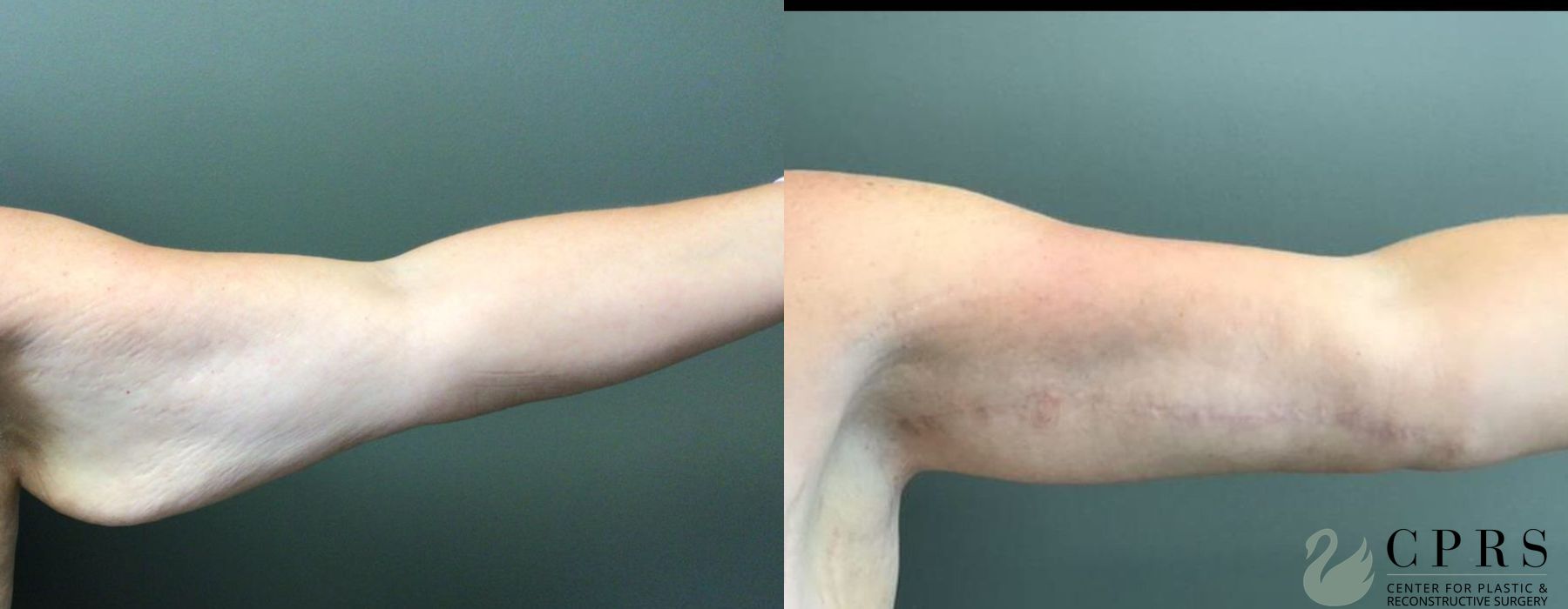 Before and after Brachioplasty case 19144 - Angle 2