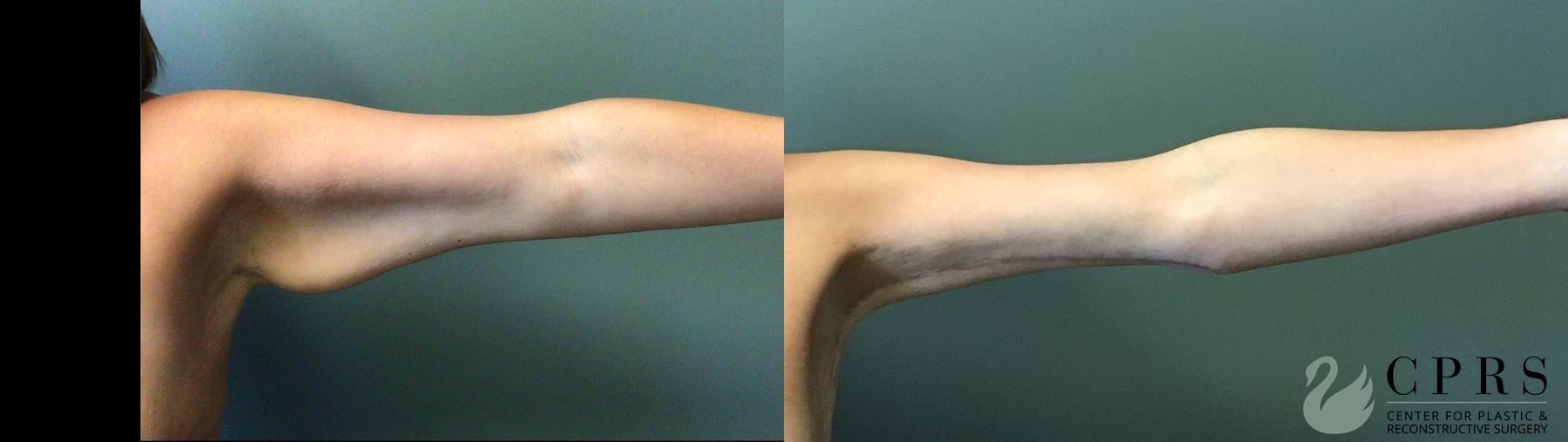 Before and after Brachioplasty case 41320