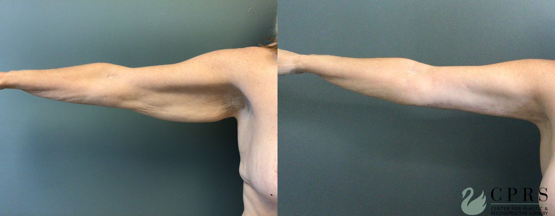 Before and after Brachioplasty case 21470 - Angle 2