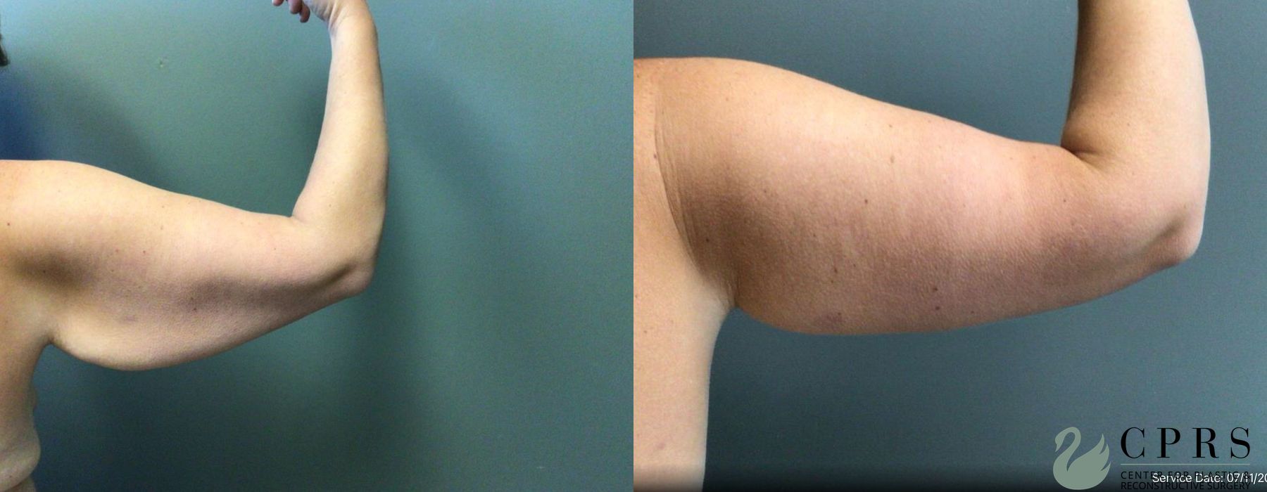 Before and after Brachioplasty case 19195