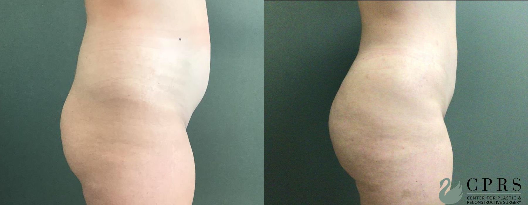 Brazilian Butt Lift - Thumbnail 2