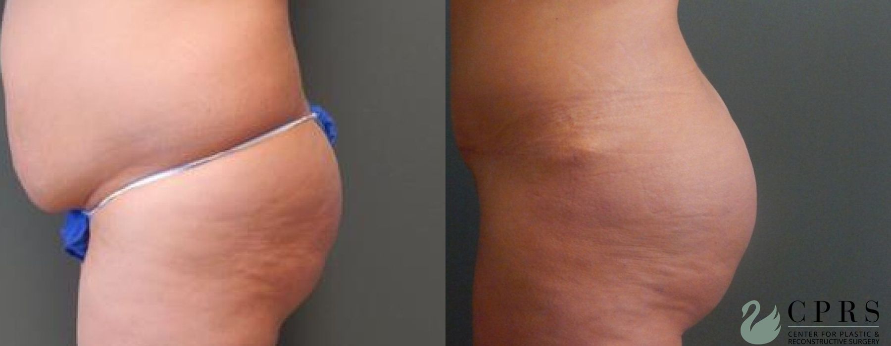 Before and after Brazilian Butt Lift case 18950 - Angle 2