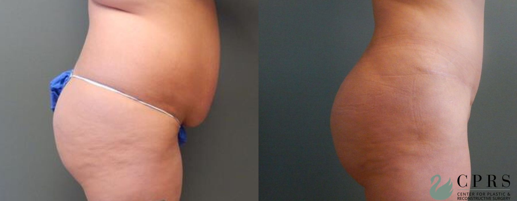 Before and after Brazilian Butt Lift case 18950