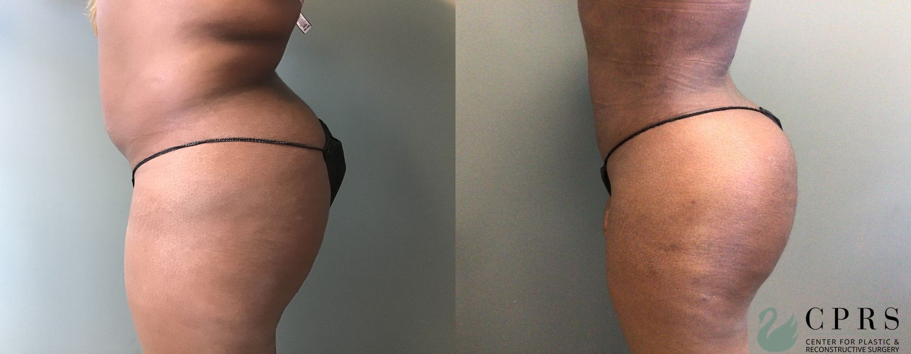 Brazilian Butt Lift - Thumbnail 3