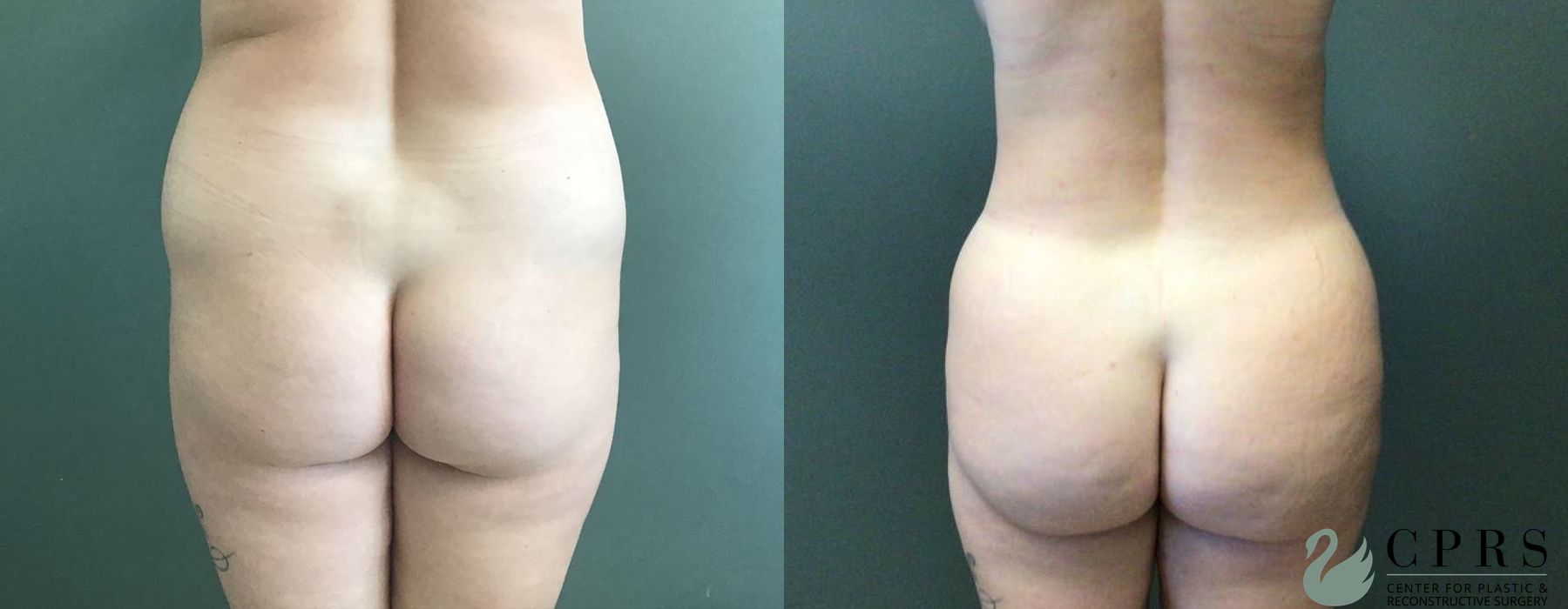 Brazilian Butt Lift - Case 239586