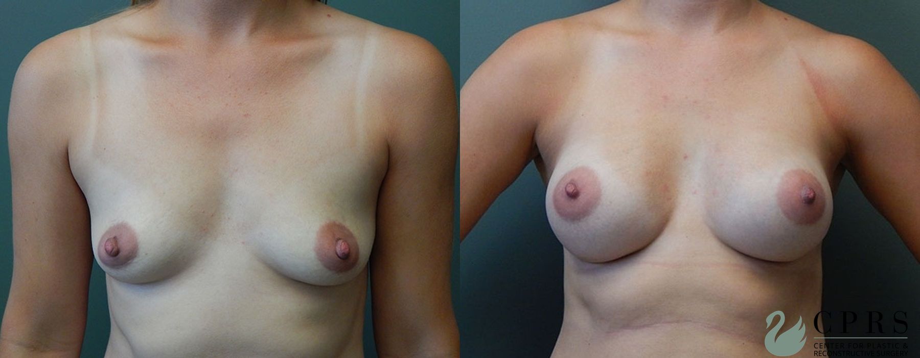 Breast Augmentation - Case 239610