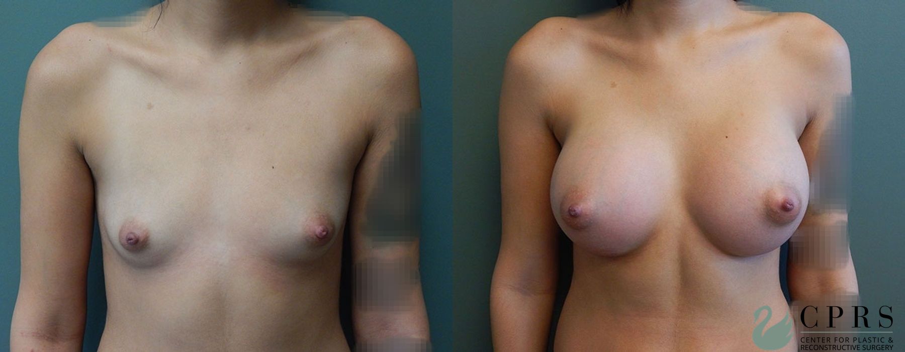 Before and after Breast Augmentation case 18929