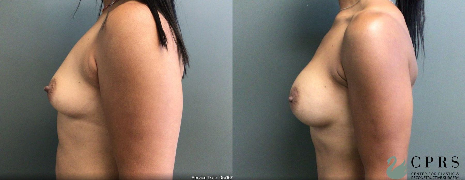 Breast Augmentation - Thumbnail 3