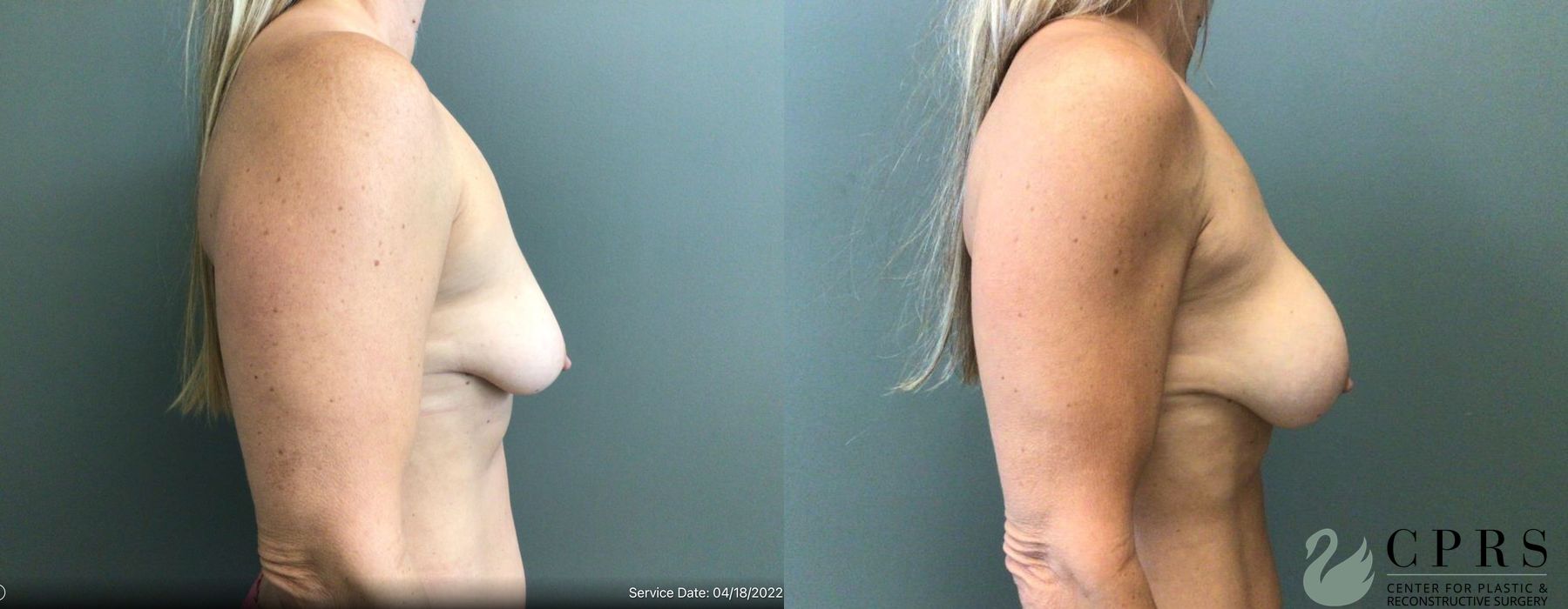 Breast Augmentation - Thumbnail 2