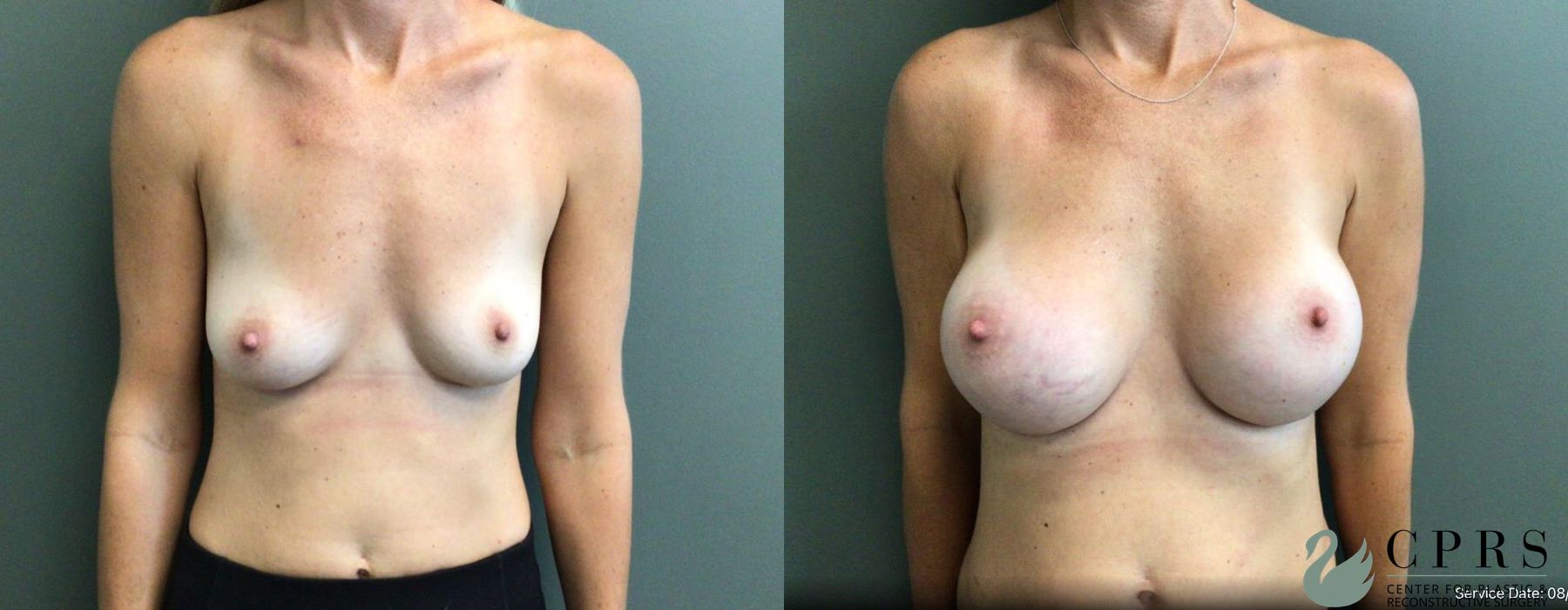 Before and after Breast Augmentation case 19202