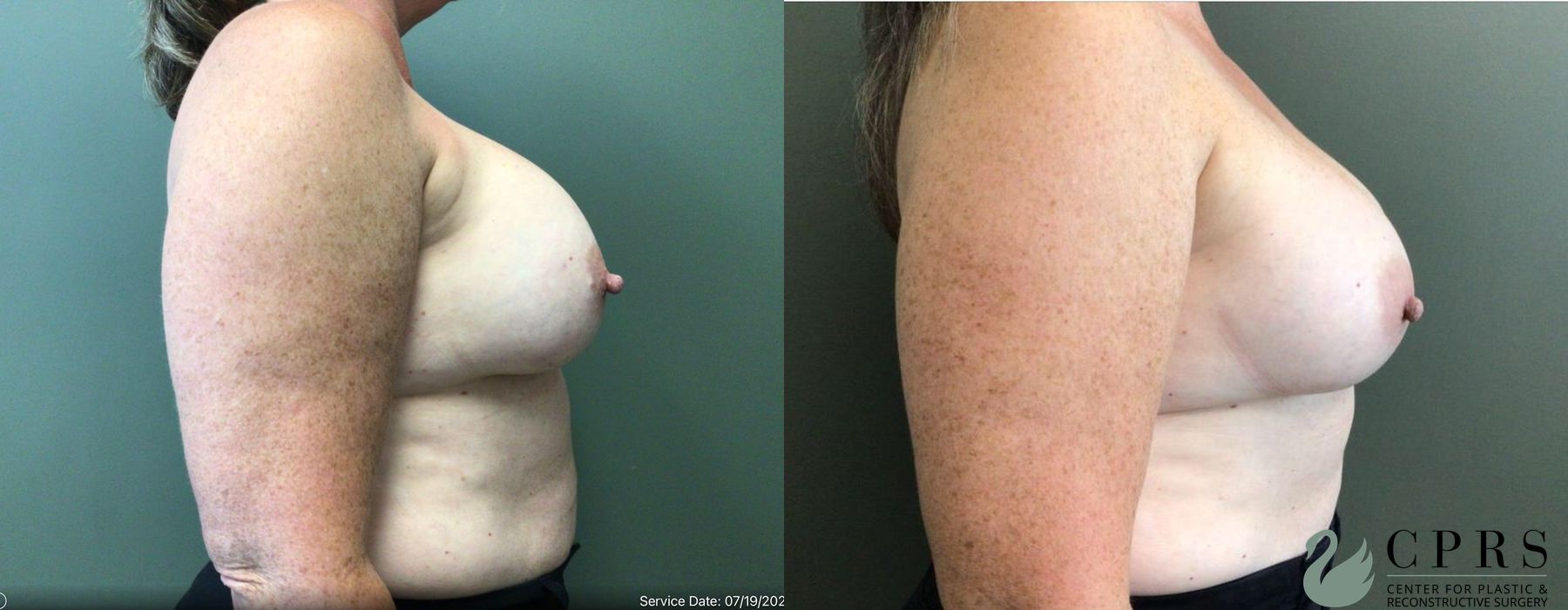 Breast Augmentation - Thumbnail 2