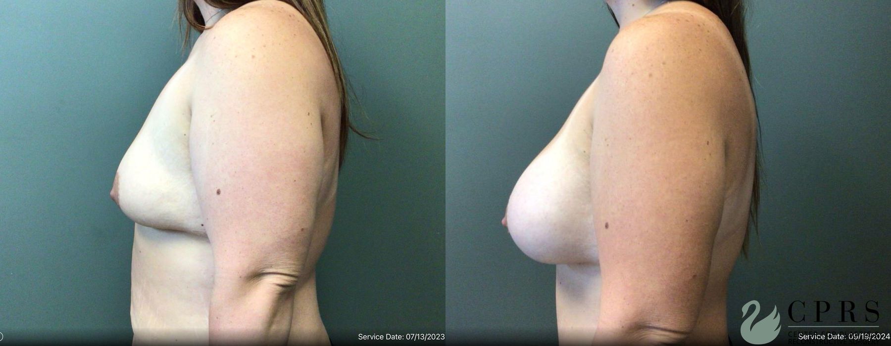 Breast Augmentation - Thumbnail 3